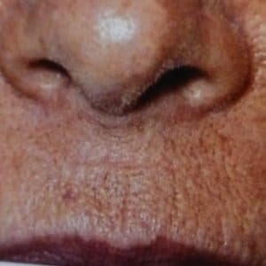 lèvre supérieure tidulée:dermabrasion avant