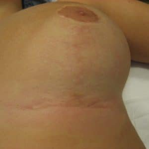 cicatrices courtes après réduction mammaire